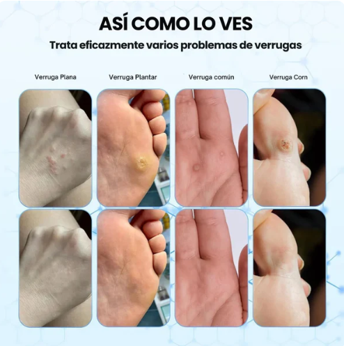 WART REMOVER Removedor de Verrugas y Lunares⭐| ENVÍO GRATIS
